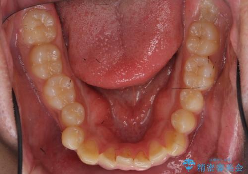 骨格性の受け口 非抜歯で下の歯を後ろに下げる インビザラインで インプラント矯正の治療前
