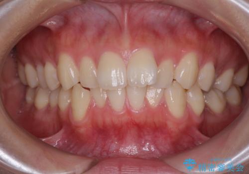 デコボコをワイヤー装置で改善 短期間で綺麗な仕上がりにの治療前