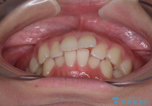 デコボコをワイヤー装置で改善 短期間で綺麗な仕上がりにの治療前