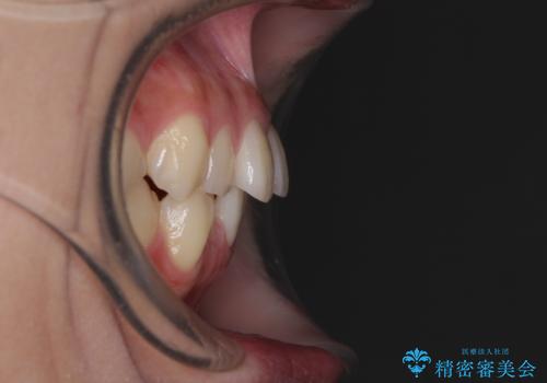 デコボコをワイヤー装置で改善 短期間で綺麗な仕上がりにの治療前