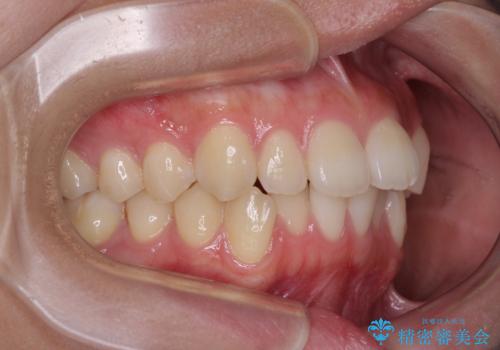 デコボコをワイヤー装置で改善 短期間で綺麗な仕上がりにの治療前