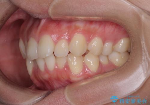 デコボコをワイヤー装置で改善 短期間で綺麗な仕上がりにの治療前