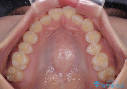 デコボコをワイヤー装置で改善 短期間で綺麗な仕上がりにの治療前