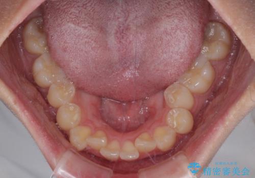 デコボコをワイヤー装置で改善 短期間で綺麗な仕上がりにの治療前