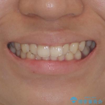 デコボコをワイヤー装置で改善 短期間で綺麗な仕上がりにの治療前(顔貌)