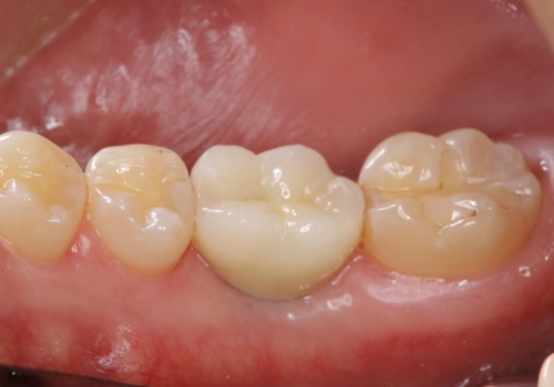 失ったままの臼歯 インプラントによる治療の治療後