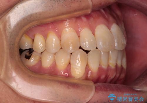 40代男性 今からでも遅くない インビザラインで綺麗な歯列を獲得の治療中