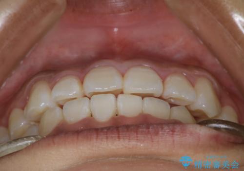 ワイヤー矯正で確実にガタつきを治したい セラミックブラケットによる治療の治療後