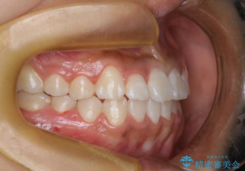 ワイヤー矯正で確実にガタつきを治したい セラミックブラケットによる治療の治療後