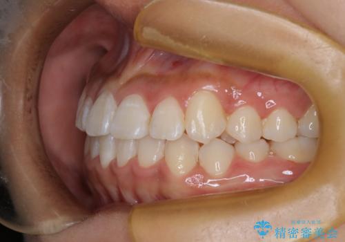 ワイヤー矯正で確実にガタつきを治したい セラミックブラケットによる治療の治療後
