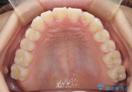 ワイヤー矯正で確実にガタつきを治したい セラミックブラケットによる治療の治療後
