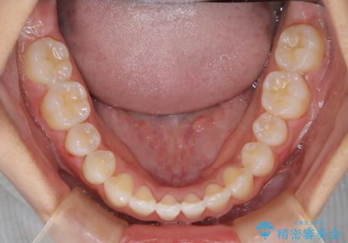 ワイヤー矯正で確実にガタつきを治したい セラミックブラケットによる治療の治療後