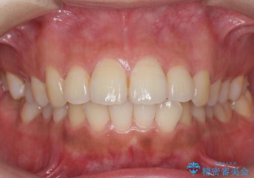 前歯の並び　モニター治療での症例 治療前