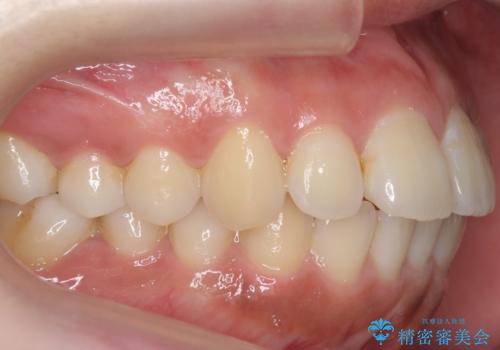 前歯の並び　モニター治療での治療前