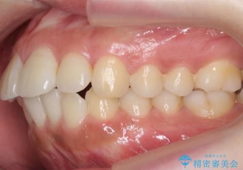 前歯の並び モニター治療での治療前