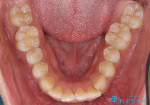 前歯の並び　モニター治療での治療前