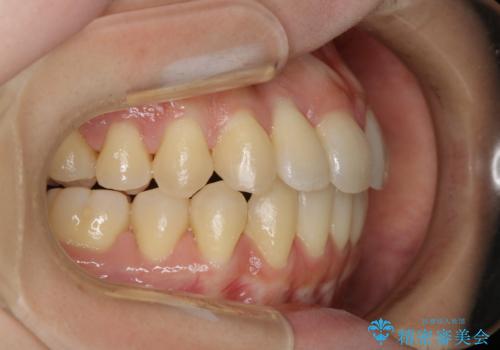 本来は外科ケース:インビザラインで前歯の重度がたつきとオープンバイトの改善の治療後