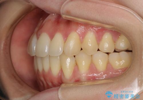本来は外科ケース:インビザラインで前歯の重度がたつきとオープンバイトの改善の治療後