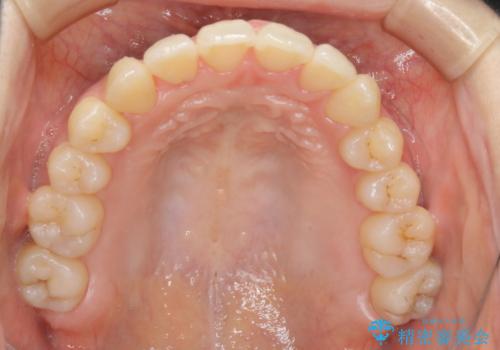 本来は外科ケース:インビザラインで前歯の重度がたつきとオープンバイトの改善の治療後