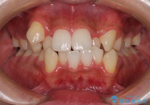 上下の八重歯とクロスバイト　ワイヤー装置での抜歯矯正の症例 治療前