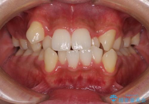 上下の八重歯とクロスバイト　ワイヤー装置での抜歯矯正の治療前