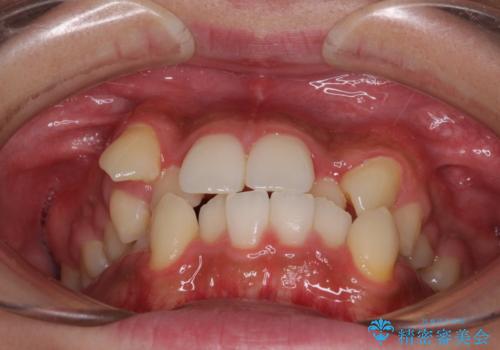 上下の八重歯とクロスバイト　ワイヤー装置での抜歯矯正の治療前