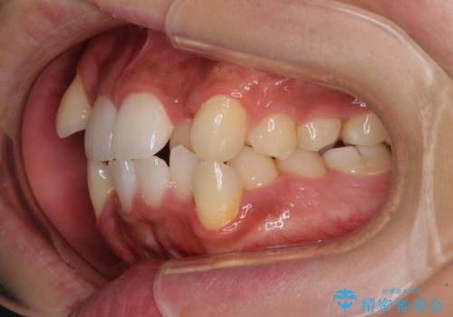 上下の八重歯とクロスバイト　ワイヤー装置での抜歯矯正の治療前