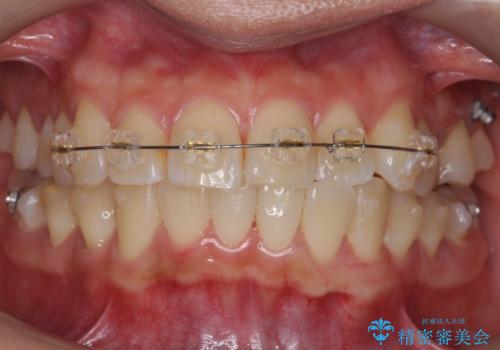 前歯と奥歯の反対咬合　部分ワイヤーとインビザラインでの治療中