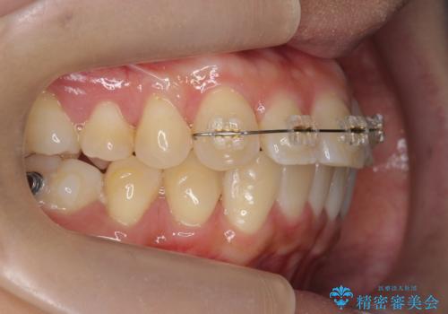 前歯と奥歯の反対咬合　部分ワイヤーとインビザラインでの治療中