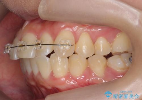 前歯と奥歯の反対咬合 部分ワイヤーとインビザラインでの治療中