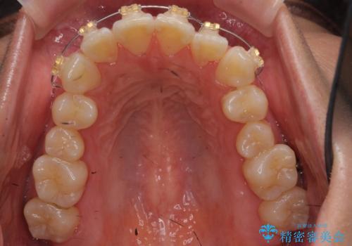 前歯と奥歯の反対咬合 部分ワイヤーとインビザラインでの治療中