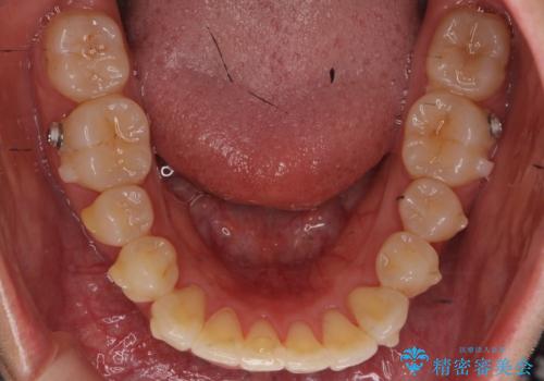 前歯と奥歯の反対咬合 部分ワイヤーとインビザラインでの治療中