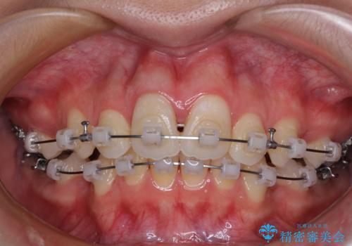 指が入るくらいに隙間のある上下前歯　抜歯矯正で横顔の印象が大きく改善の治療中
