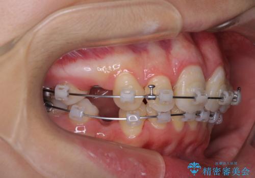 指が入るくらいに隙間のある上下前歯 抜歯矯正で横顔の印象が大きく改善の治療中