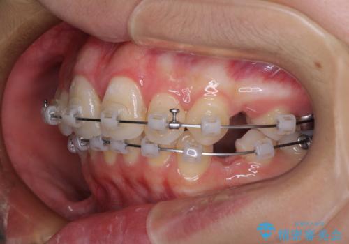 指が入るくらいに隙間のある上下前歯 抜歯矯正で横顔の印象が大きく改善の治療中