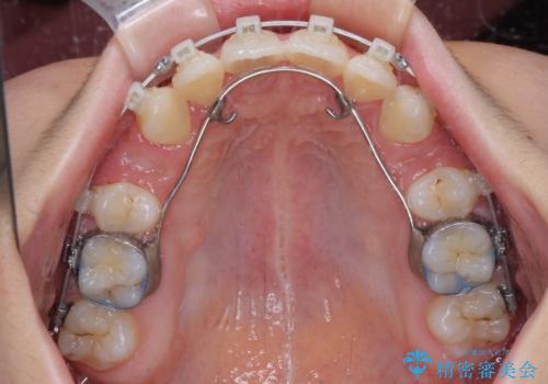指が入るくらいに隙間のある上下前歯 抜歯矯正で横顔の印象が大きく改善の治療中