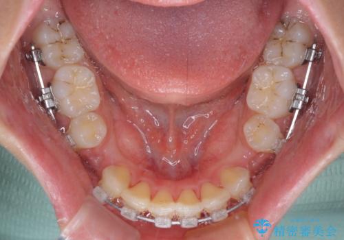 指が入るくらいに隙間のある上下前歯 抜歯矯正で横顔の印象が大きく改善の治療中