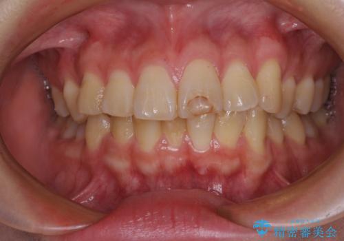 変色した前歯の詰め物 オールセラミッククラウンで本物の前歯のようにの治療前