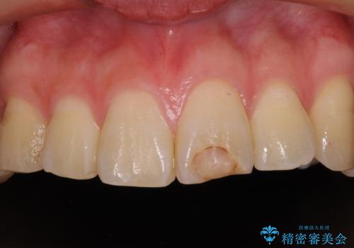 変色した前歯の詰め物　オールセラミッククラウンで本物の前歯のようにの治療前