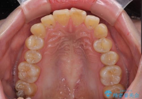 変色した前歯の詰め物　オールセラミッククラウンで本物の前歯のようにの治療前