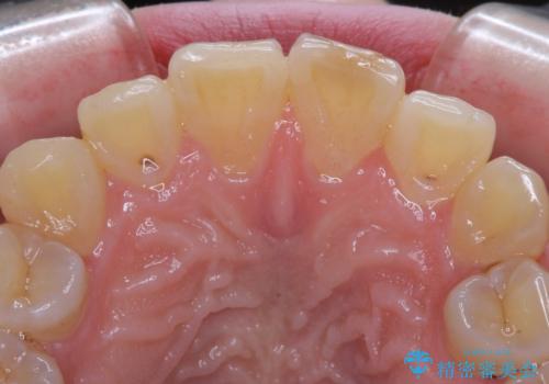 変色した前歯の詰め物 オールセラミッククラウンで本物の前歯のようにの治療前