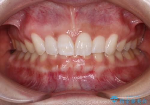 前歯のデコボコを治したい インビザライン矯正治療の症例 治療後