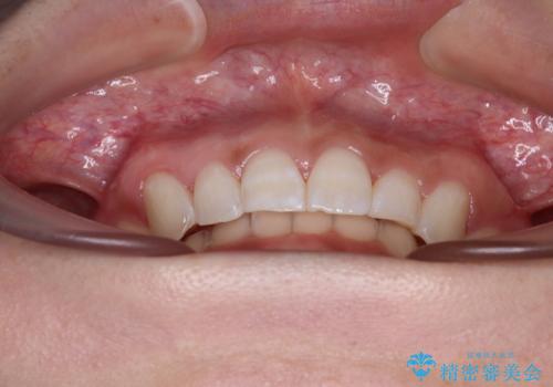 前歯のデコボコを治したい インビザライン矯正治療の治療後