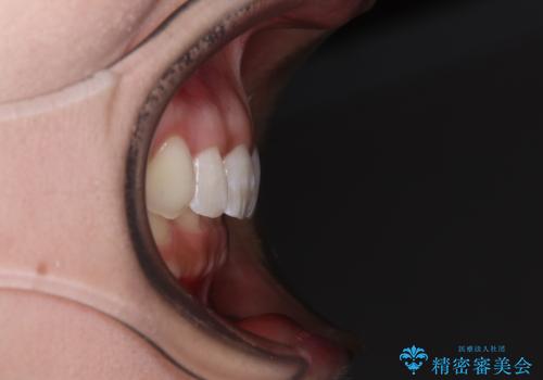 前歯のデコボコを治したい インビザライン矯正治療の治療後