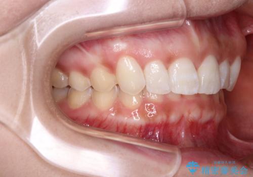 前歯のデコボコを治したい インビザライン矯正治療の治療後