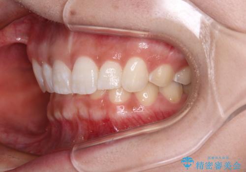 前歯のデコボコを治したい インビザライン矯正治療の治療後