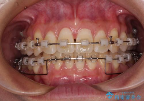 前に飛び出した上顎前歯をスッキリと引っ込める ワイヤー装置での矯正治療の治療中