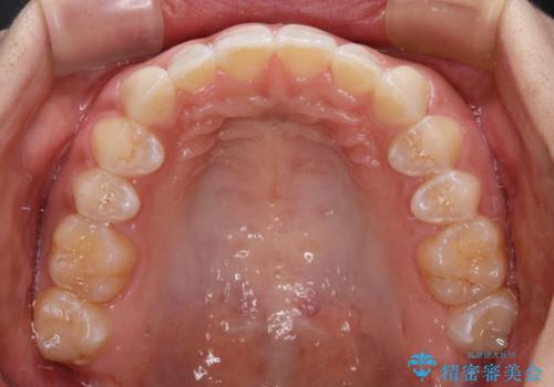 前歯のデコボコを治したい インビザライン矯正治療の治療後