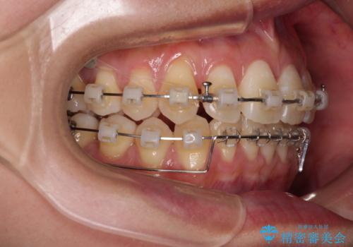 前に飛び出した上顎前歯をスッキリと引っ込める ワイヤー装置での矯正治療の治療中