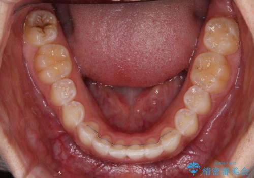 前歯のデコボコを治したい インビザライン矯正治療の治療後